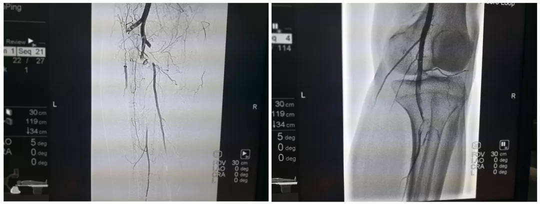 新技术 | 我院介入科成功救治一名双下肢急性动脉栓塞